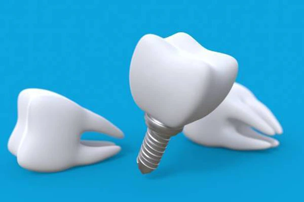 Dental Implants